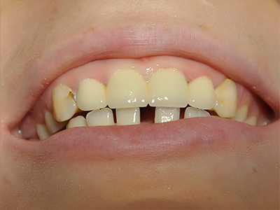 Коронки на основе диоксида циркония на 4 передних зуба