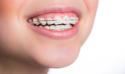 Исправление прикуса