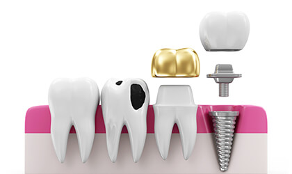 Протезирование зубов